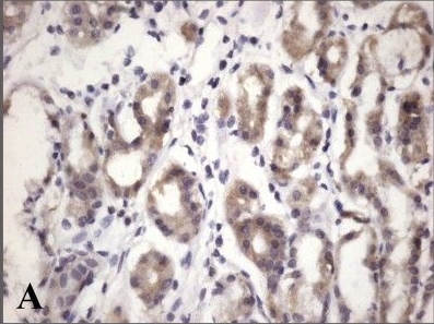 Expression of plakophilins (PKP1, PKP2, and PKP3) in gastric cancers.