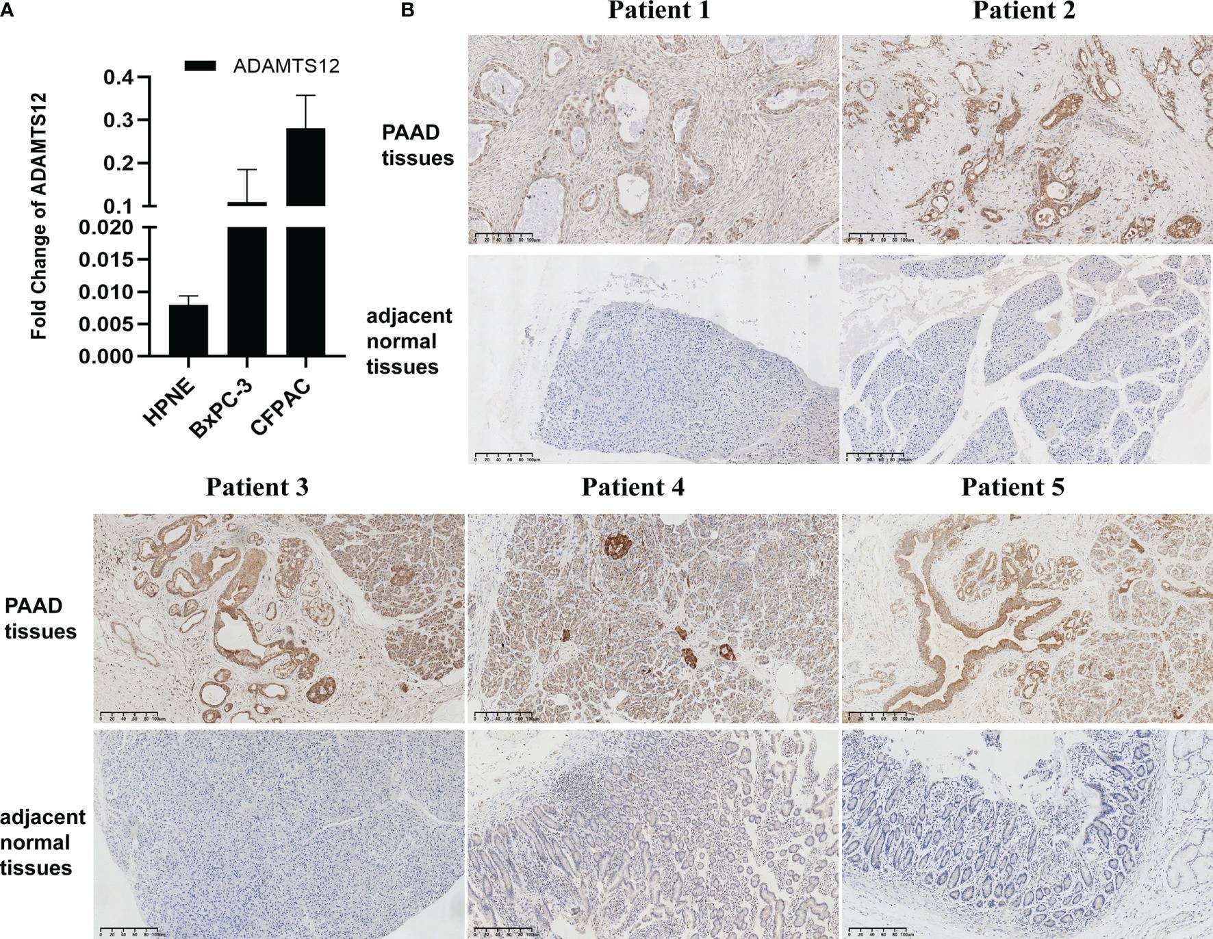 Fig.3.A showing Immunohistochemistry from the publication: An Integrated Pan-Cancer Analysis of ADAMTS12 and Its Potential Implications in Pancreatic Adenocarcinoma.