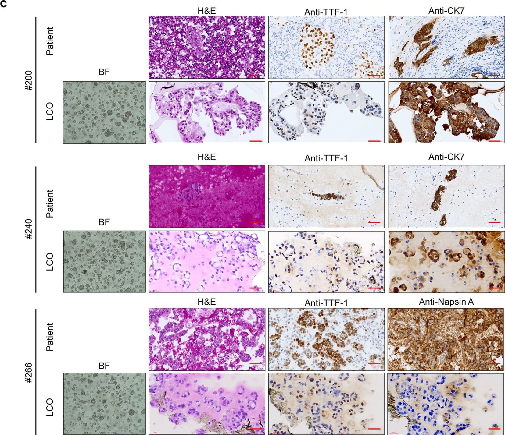 Fig.3.C showing Immunohistochemistry in a Homo sapiens (Human) sample from the publication: Prediction of TKI response in EGFR-mutant lung cancer patients-derived organoids using malignant pleural effusion.