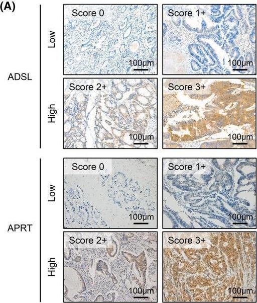 Fig.3.A showing Immunohistochemistry from the publication: Elucidating prognostic significance of purine metabolism in colorectal cancer through integrating data from transcriptomic, immunohistochemical, and single-cell RNA sequencing analysis.