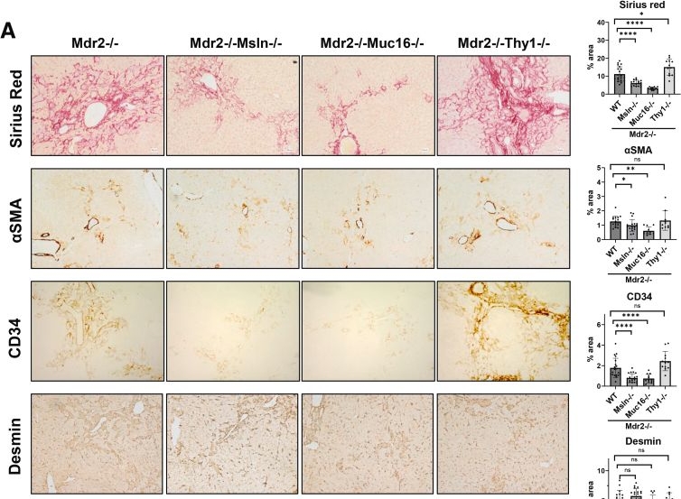 Fig.4.A showing Immunohistochemistry in a Mus musculus (House mouse) sample from the publication: Mesothelin/Mucin 16 Signaling in Activated Portal Fibroblasts Drives the Development of Cholestatic Fibrosis and Hepatocellular Carcinoma in Aged Female Multidrug Resistance Protein 2 Knockout Mice.