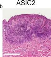 Fig.3.B showing Immunohistochemistry from the publication: Expression Profiles of ASIC1/2 and TRPV1/4 in Common Skin Tumors.