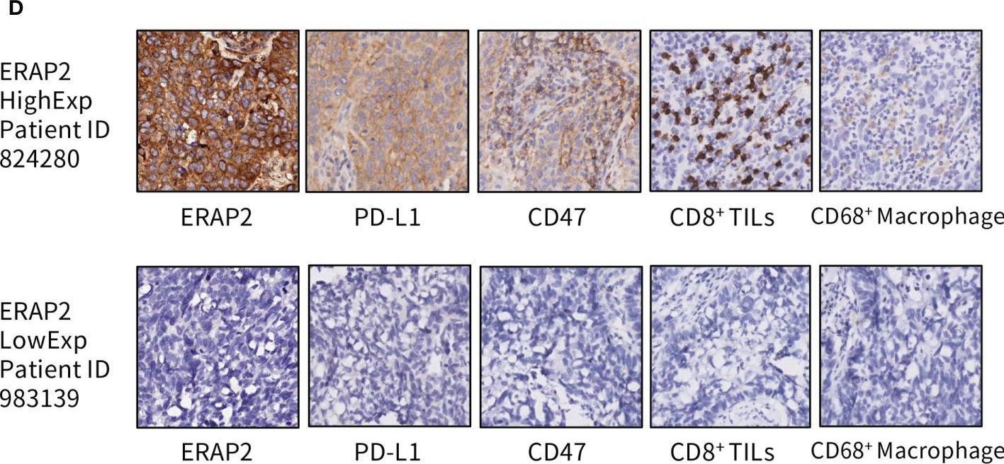 Fig.6.D showing Immunohistochemistry in a Homo sapiens (Human) sample from the publication: ERAP2 Is Associated With Immune Infiltration and Predicts Favorable Prognosis in SqCLC.