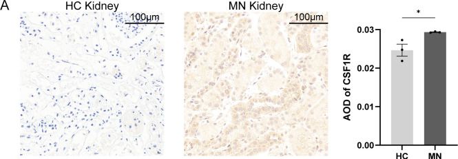 Fig.6.A showing Immunohistochemistry in a Homo sapiens (Human) sample from the publication: Identification of key genes in membranous nephropathy and non-alcoholic fatty liver disease by bioinformatics and machine learning.