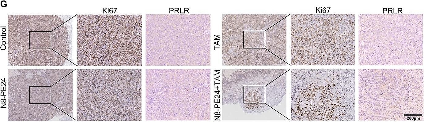 Fig.6.G showing Immunohistochemistry in a Homo sapiens (Human) sample from the publication: The immunotoxin targeting PRLR increases tamoxifen sensitivity and enhances the efficacy of chemotherapy in breast cancer.