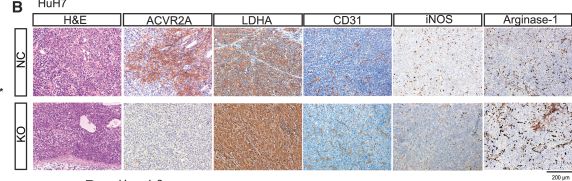 Fig.3.B showing Immunohistochemistry in a Homo sapiens (Human) sample from the publication: ACVR2A attenuation impacts lactate production and hyperglycolytic conditions attracting regulatory T&nbsp;cells in hepatocellular carcinoma.