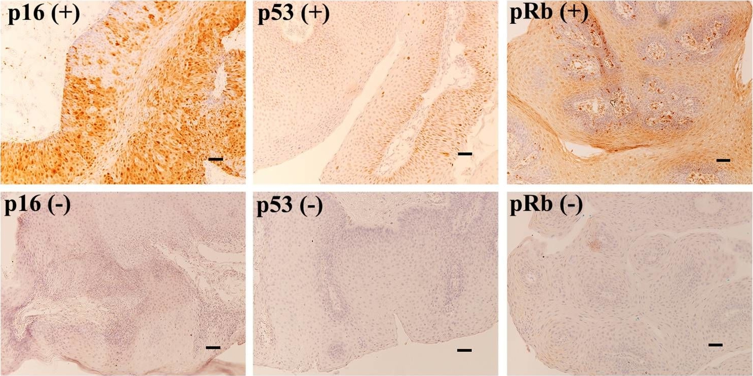 Methylation of CpG sites in the upstream regulatory region, physical status and mRNA expression of HPV-6 in adult-onset laryngeal papilloma.