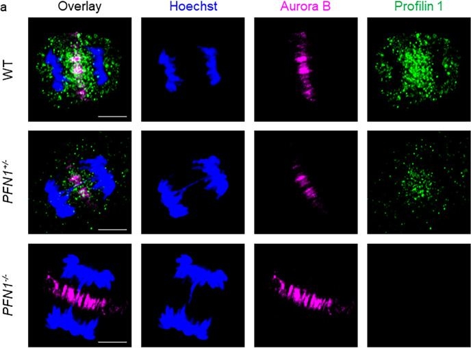 Fig.2.A showing Immunocytochemistry-immunofluorescence in a Homo sapiens (Human) sample from the publication: Profilin 1 deficiency drives mitotic defects and reduces genome stability.