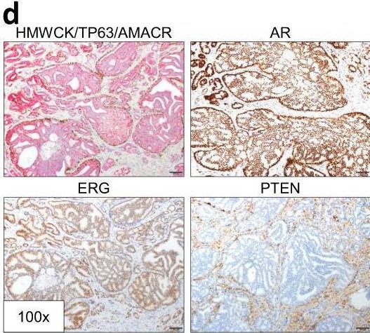 Fig.1.D showing Immunohistochemistry from the publication: Single cell analysis of cribriform prostate cancer reveals cell intrinsic and tumor microenvironmental pathways of aggressive disease.