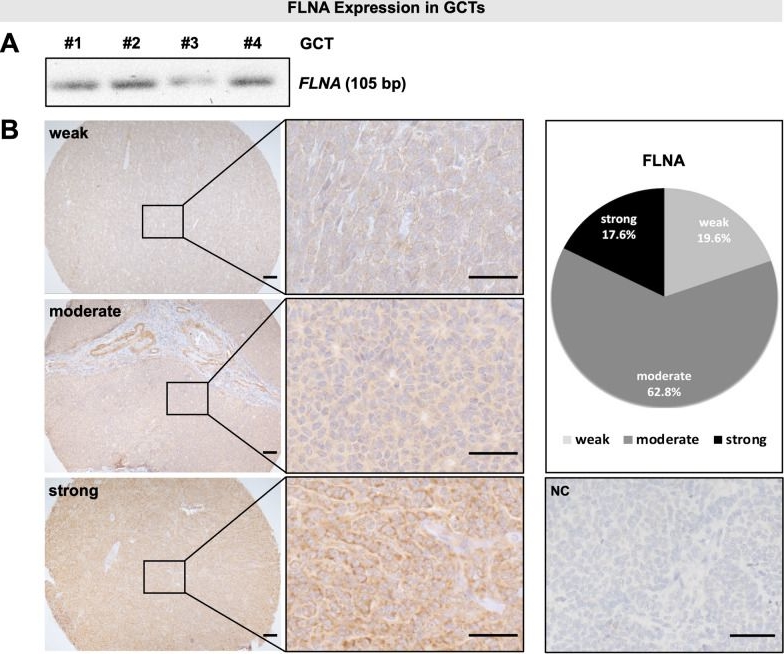 Fig.1.A showing Immunohistochemistry in a Homo sapiens (Human) sample from the publication: Knockout of filamin A in KGN granulosa tumor cells impairs proliferation, cell cycle progression, migration, and cytoskeletal organization under mechanical stress.