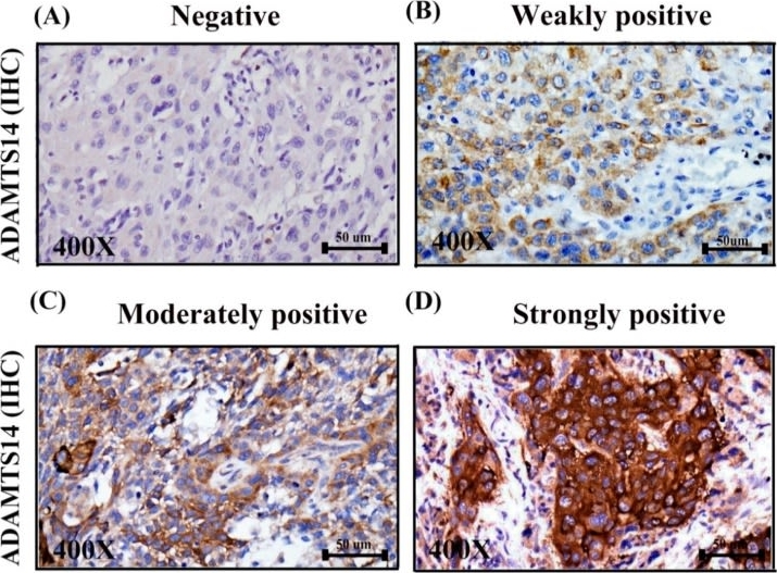 Fig.1.A,B,C,D showing Immunohistochemistry in a Homo sapiens (Human) sample from the publication: Decreased Cytoplasmic Expression of ADAMTS14 Is Correlated with Reduced Survival Rates in Oral Squamous Cell Carcinoma Patients.
