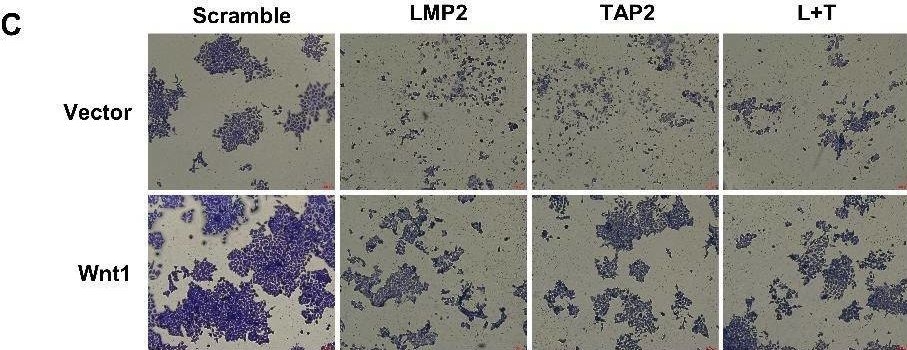 Fig.6.C showing Immunohistochemistry in a Homo sapiens (Human) sample from the publication: LMP2 and TAP2 impair tumor growth and metastasis by inhibiting Wnt/β-catenin signaling pathway and EMT in cervical cancer.
