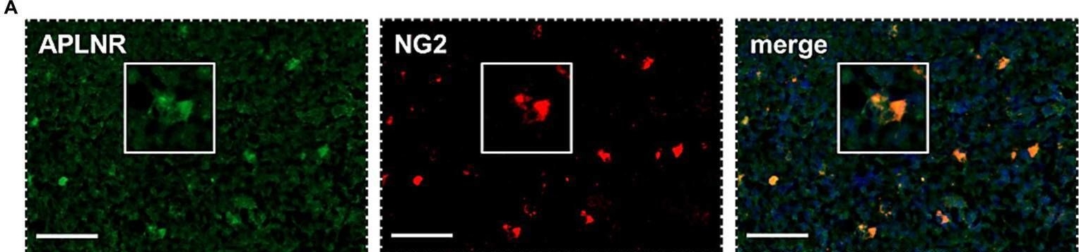 Fig.6.A showing Immunohistochemistry-immunofluorescence from the publication: Expression of the apelin receptor, a novel potential therapeutic target, and its endogenous ligands in diverse stem cell populations in human glioblastoma.