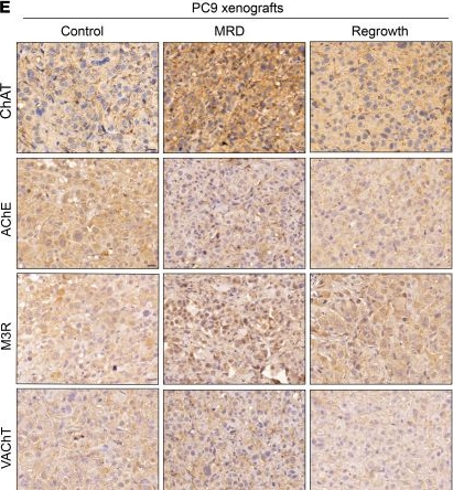 Fig.3.E showing Immunohistochemistry in a Homo sapiens (Human) sample from the publication: Targeting acetylcholine signaling modulates persistent drug tolerance in EGFR-mutant lung cancer and impedes tumor relapse.