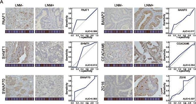 Fig.4.A showing Immunohistochemistry in a Homo sapiens (Human) sample from the publication: Proteomic characteristics reveal the signatures and the risks of T1 colorectal cancer metastasis to lymph nodes.