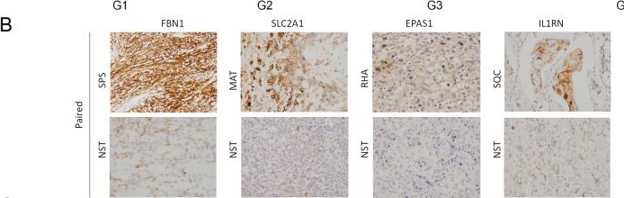 Fig.4.B showing Immunohistochemistry from the publication: Transcriptomic alterations underlying metaplasia into specific metaplastic components in metaplastic breast carcinoma.