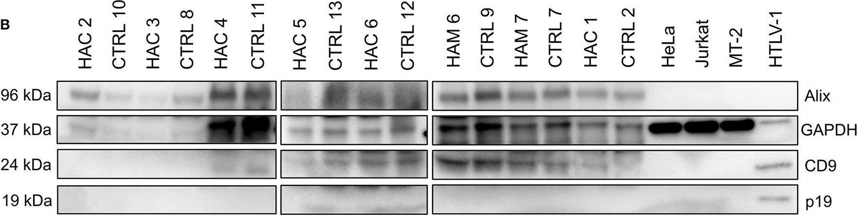 Fig.2.B showing Western Blotting from the publication: The Expression of Tax and HBZ Genes in Serum-Derived Extracellular Vesicles From HTLV-1 Carriers Correlates to Proviral Load and Inflammatory Markers.