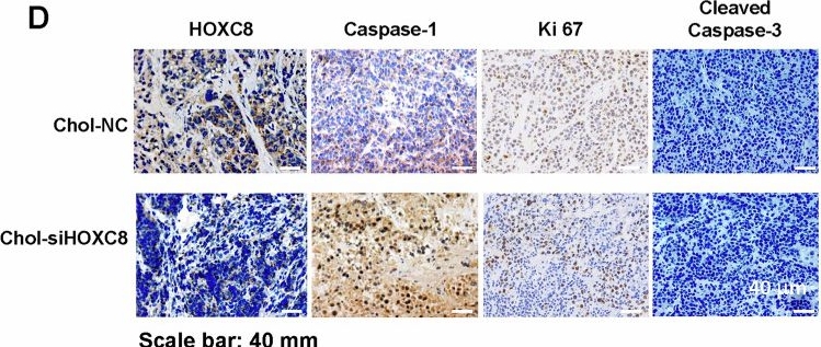 Fig.7.D showing Immunohistochemistry in a Homo sapiens (Human) sample from the publication: HOXC8 impacts lung tumorigenesis by preventing pyroptotic cell death through the suppression of caspase-1 expression.