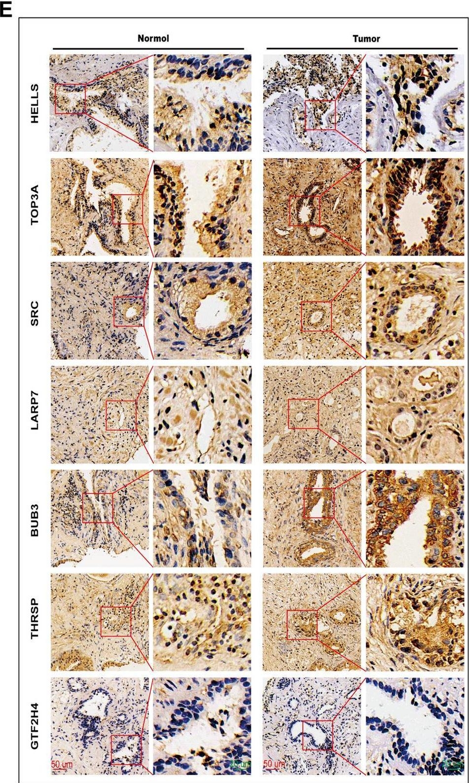 Fig.4.E showing Immunohistochemistry in a Homo sapiens (Human) sample from the publication: Predicting prostate adenocarcinoma patients' survival and immune signature: a novel risk model based on telomere-related genes.