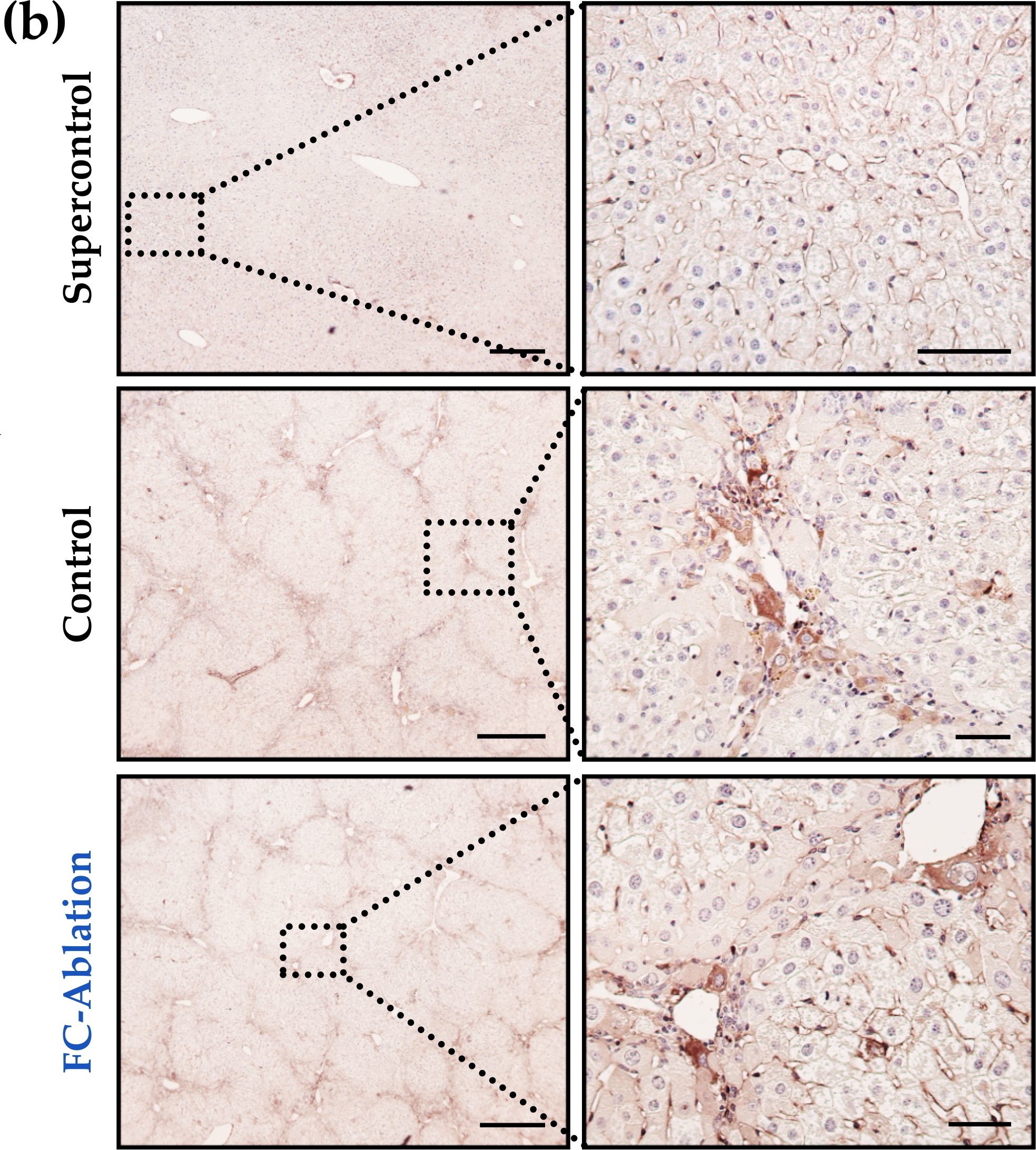 Depletion of Bone Marrow-Derived Fibrocytes Attenuates TAA-Induced Liver Fibrosis in Mice.