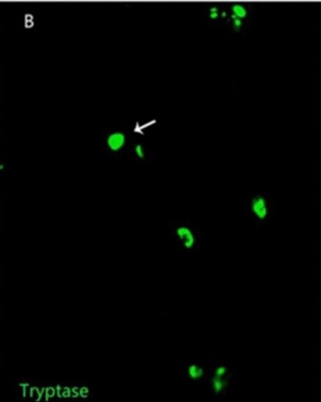 Fig.9.B showing Immunocytochemistry-immunofluorescence in a Homo sapiens (Human) sample from the publication: Presence and significance of telocytes in cholelithiasis and biliary dilatation in benign biliary disorders.