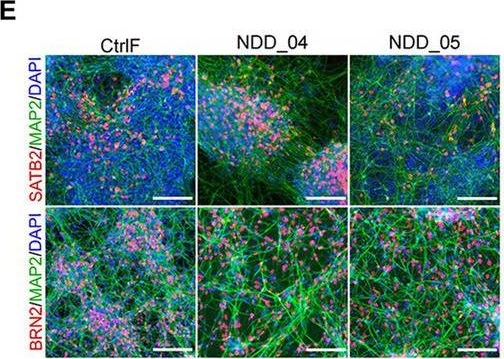 Fig.1.E showing Immunocytochemistry-immunofluorescence in a Homo sapiens (Human) sample from the publication: Characterization of a loss-of-function NSF attachment protein beta mutation in monozygotic triplets affected with epilepsy and autism using cortical neurons from proband-derived and CRISPR-corrected induced pluripotent stem cell lines.
