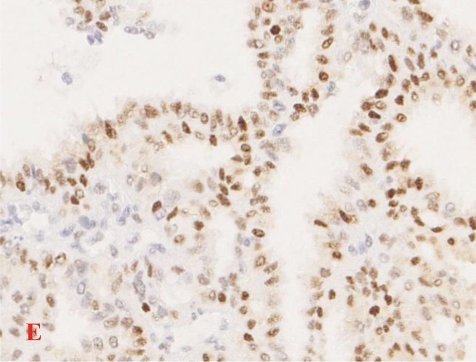 Fig.2.E showing Immunohistochemistry in a Homo sapiens (Human) sample from the publication: Low thyroid hormone receptor alpha-2 (THRα-2) tumor expression is associated with unfavorable tumor characteristics and high breast cancer mortality.