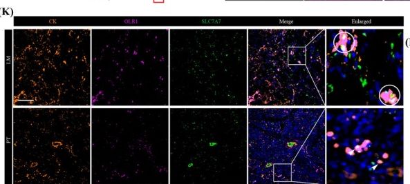 Fig.4.K showing Immunohistochemistry-immunofluorescence from the publication: Single-Cell Transcriptomic Analysis Identifies a Novel OLR1+ SLC7A7+ Liver-Enriched Metastatic Subset With Immunometabolic Rewiring in Pancreatic Cancer.