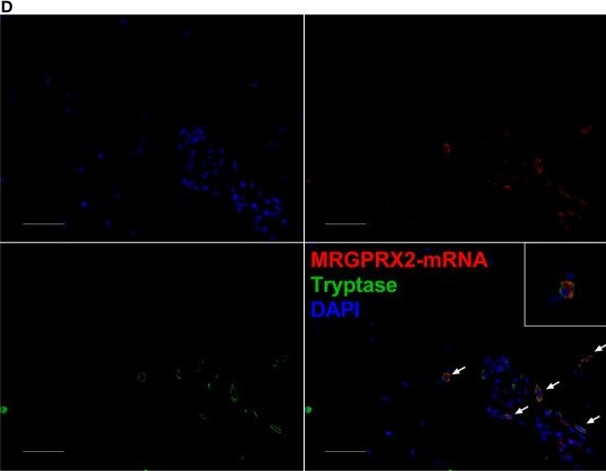 Fig.2.D showing Immunohistochemistry-immunofluorescence in a Homo sapiens (Human) sample from the publication: The Number of MRGPRX2-Expressing Cells Is Increased in Skin Lesions of Patients With Indolent Systemic Mastocytosis, But Is Not Linked to Symptom Severity.
