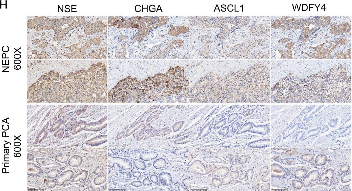 Fig.4.H showing Immunohistochemistry in a Homo sapiens (Human) sample from the publication: New insights into markers for distinguishing neuroendocrine prostate cancer: evidence from single-cell analysis.