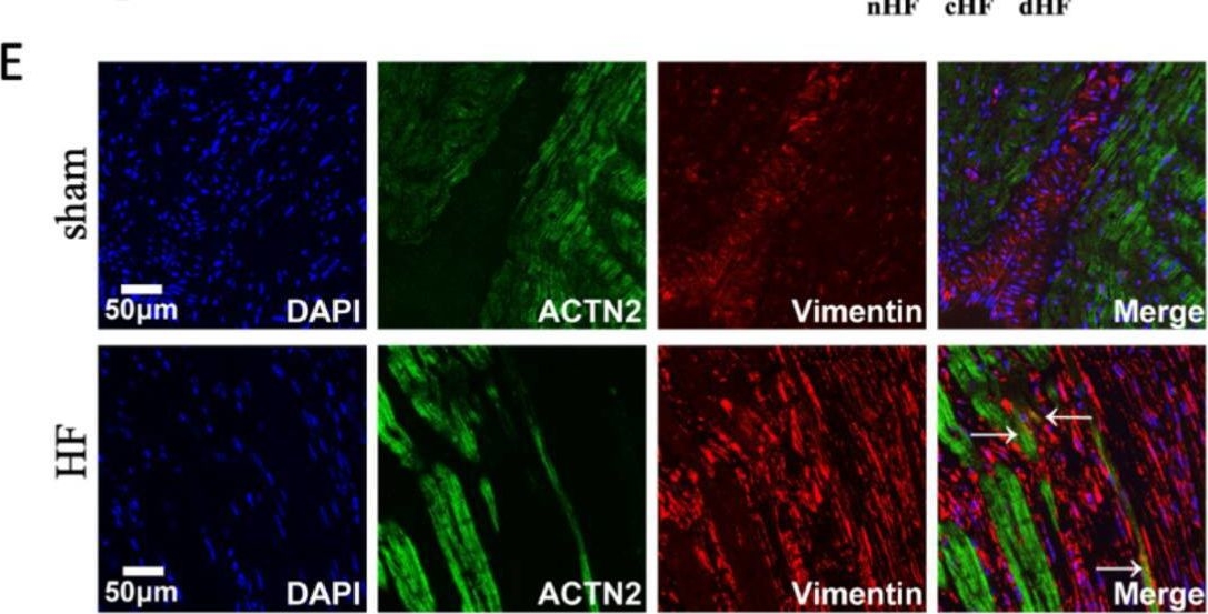Fig.6.E showing Immunohistochemistry-immunofluorescence from the publication: Cellular Phenotypic Transformation in Heart Failure Caused by Coronary Heart Disease and Dilated Cardiomyopathy: Delineating at Single-Cell Level.