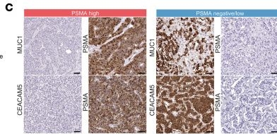 Fig.4.C showing Immunohistochemistry from the publication: Reversible epigenetic alterations mediate PSMA expression heterogeneity in advanced metastatic prostate cancer.