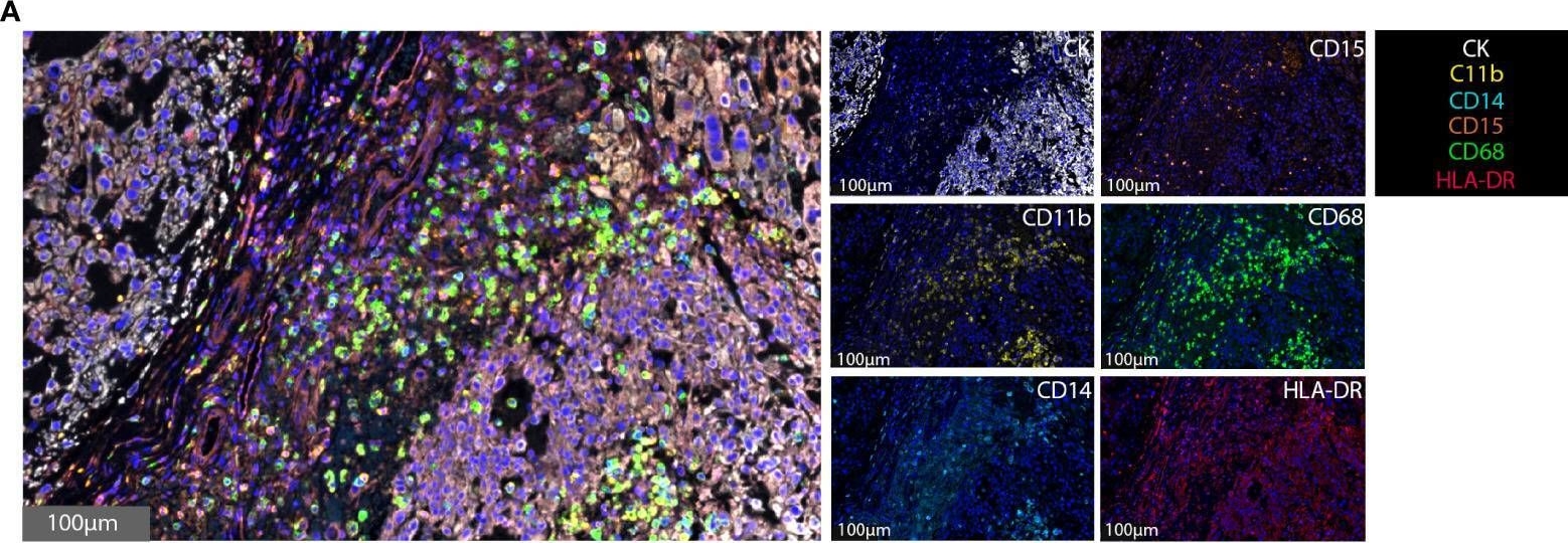 Fig.1.A showing Immunohistochemistry-immunofluorescence in a Homo sapiens (Human) sample from the publication: Multi-spectral immunofluorescence evaluation of the myeloid, T cell, and natural killer cell tumor immune microenvironment in chordoma may guide immunotherapeutic strategies.