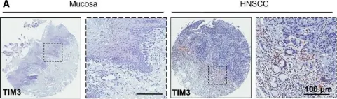 Fig.1.A showing Immunohistochemistry from the publication: T-cell immunoglobulin mucin 3 blockade drives an antitumor immune response in head and neck cancer.