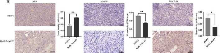 Fig.4.B showing Immunohistochemistry in a Homo sapiens (Human) sample from the publication: Alpha-Fetoprotein Stimulates Cleavage of Membranal MICA/B on Liver Cancer Cell Lead to Escape Immune Surveillance of Natural Killer Cells.