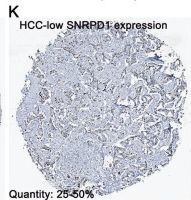 Fig.2.K showing Immunohistochemistry from the publication: The diagnostic and prognostic significance of small nuclear ribonucleoprotein Sm D1 aberrantly high expression in hepatocellular carcinoma.