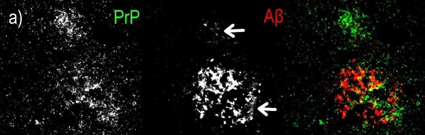 Fig.2.A showing Immunohistochemistry-paraffin in a Homo sapiens (Human) sample from the publication: Extracellular Protein Aggregates Colocalization and Neuronal Dystrophy in Comorbid Alzheimer's and Creutzfeldt-Jakob Disease: A Micromorphological Pilot Study on 20 Brains.
