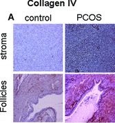 Fig.1.A showing Immunohistochemistry from the publication: Lysyl oxidase interacts with AGE signalling to modulate collagen synthesis in polycystic ovarian tissue.