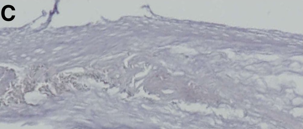 Fig.6.C showing Immunohistochemistry in a Homo sapiens (Human) sample from the publication: Differential Protein Expression in Congenital and Acquired Cholesteatomas.