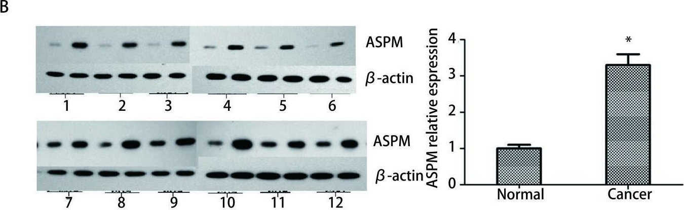Fig.2.B showing Western Blotting from the publication: Expression of ASPM in Lung Adenocarcinoma and Its Relationship with Development and Prognosis