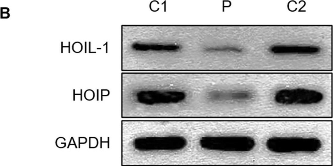Fig.3.B showing Western Blotting in a Homo sapiens (Human) sample from the publication: Polyglucosan body myopathy 1 may cause cognitive impairment: a case report from China.