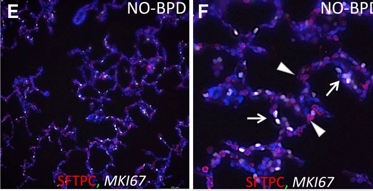 Fig.7.E showing Immunohistochemistry-immunofluorescence in a Homo sapiens (Human) sample from the publication: Hedgehog-responsive PDGFRa(+) fibroblasts maintain a unique pool of alveolar epithelial progenitor cells during alveologenesis.