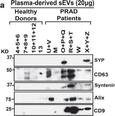 Fig.4.A showing Western Blotting in a Homo sapiens (Human) sample from the publication: Neuroendocrine gene subsets are uniquely dysregulated in prostate adenocarcinoma.