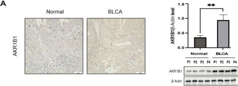 Fig.14.A showing Immunohistochemistry from the publication: Exploration and validation of a novel reactive oxygen species-related signature for predicting the prognosis and chemotherapy response of patients with bladder cancer.