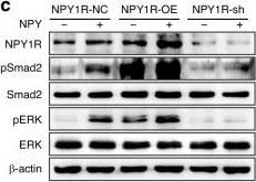 Fig.4.C showing Western Blotting from the publication: Crosstalk of NPY and TGFβ orchestrates the signaling to facilitate perineural invasion of oral squamous cell carcinoma.
