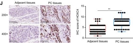 Fig.1.J showing Immunohistochemistry from the publication: HOXC4 promotes proliferation of pancreatic cancer cells by increasing LDHA-mediated glycolysis.