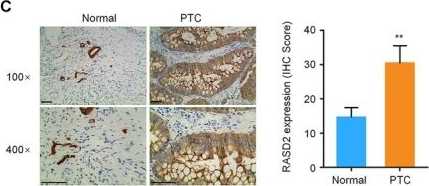 Fig.1.C showing Immunohistochemistry from the publication: Modulation of RASD2 by miRNA-485-5p Drives Thyroid Cancer Progression and Metastasis.