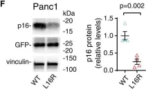 Fig.2.F showing Western Blotting from the publication: A rare germline CDKN2A variant (47T>G; p16-L16R) predisposes carriers to pancreatic cancer by reducing cell cycle inhibition.