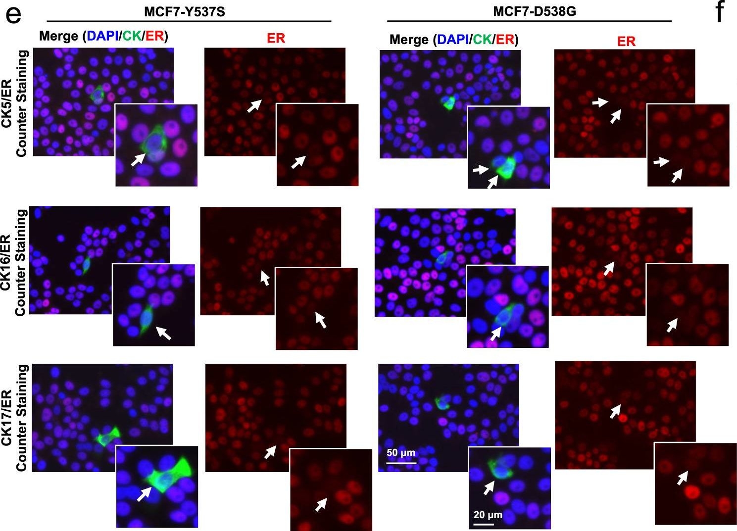 Fig.3.E showing Immunocytochemistry-immunofluorescence in a Homo sapiens (Human) sample from the publication: ESR1 mutant breast cancers show elevated basal cytokeratins and immune activation.
