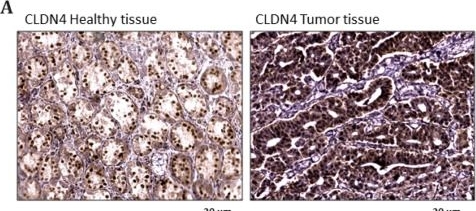 Fig.2.A showing Immunohistochemistry in a Homo sapiens (Human) sample from the publication: Targeting CEACAM5: Biomarker Characterization and Fluorescent Probe Labeling for Image-Guided Gastric Cancer Surgery.